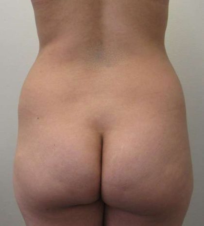 Liposuction Before & After Patient #8891