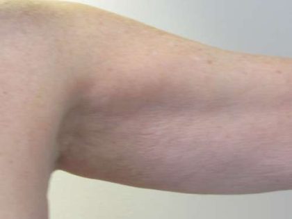 Bodytite Before & After Patient #6178