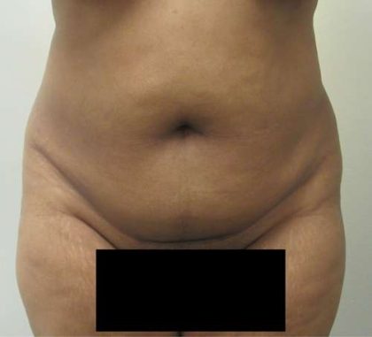 Liposuction Before & After Patient #8896