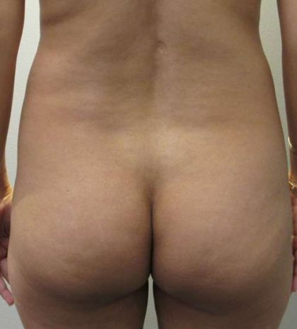 Liposuction Before & After Patient #8917