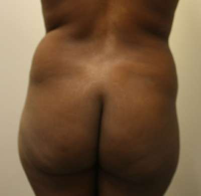 Liposuction Before & After Patient #8925