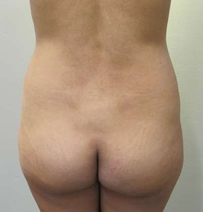 Liposuction Before & After Patient #8930