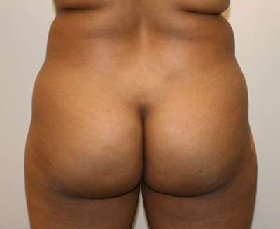 Liposuction Before & After Patient #8940