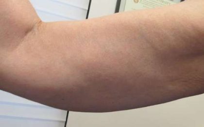 Bodytite Before & After Patient #6181