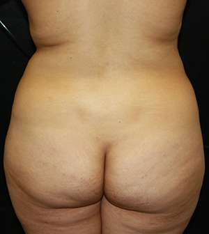Liposuction Before & After Patient #8948