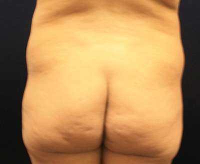Liposuction Before & After Patient #8969
