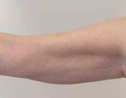 Bodytite Before & After Patient #6184