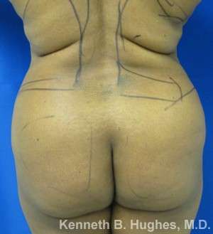 Liposuction Before & After Patient #9017