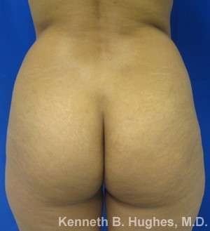 Liposuction Before & After Patient #9040