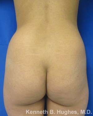Liposuction Before & After Patient #9043