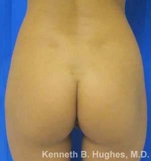 Liposuction Before & After Patient #9046