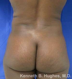 Liposuction Before & After Patient #9076