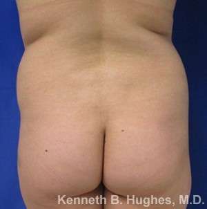 Liposuction Before & After Patient #9087