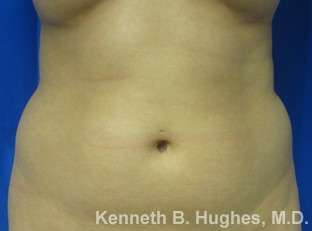 Liposuction Before & After Patient #9092