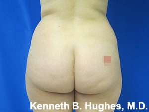 Liposuction Before & After Patient #9120
