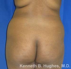 Liposuction Before & After Patient #9123