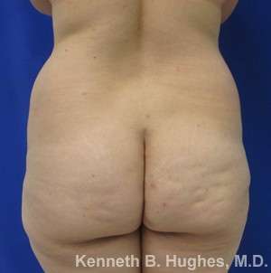 Liposuction Before & After Patient #9128