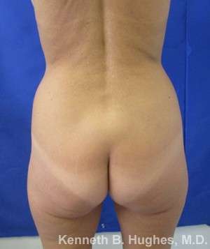 Liposuction Before & After Patient #9131
