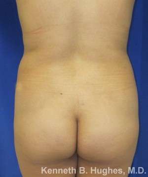 Liposuction Before & After Patient #9136