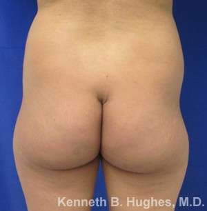 Liposuction Before & After Patient #9141