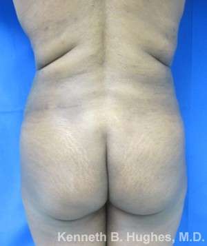 Liposuction Before & After Patient #9152
