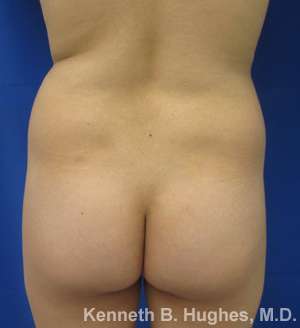 Liposuction Before & After Patient #9160