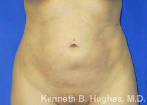 Liposuction Before & After Patient #9167