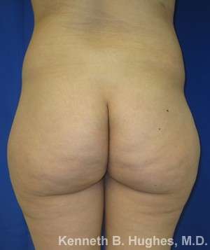 Liposuction Before & After Patient #9172