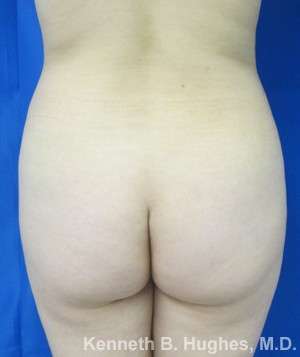 Liposuction Before & After Patient #9175