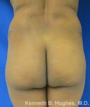 Liposuction Before & After Patient #9183