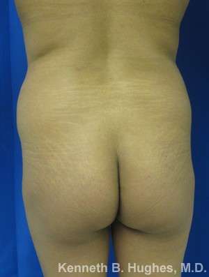 Liposuction Before & After Patient #9196