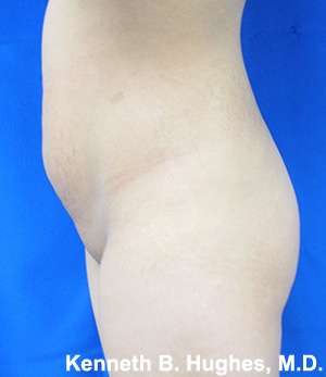 Liposuction Before & After Patient #9199