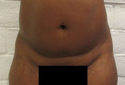 Liposuction Before & After Patient #9210