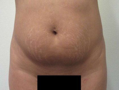 Liposuction Before & After Patient #9213