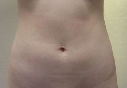 Liposuction Before & After Patient #9216