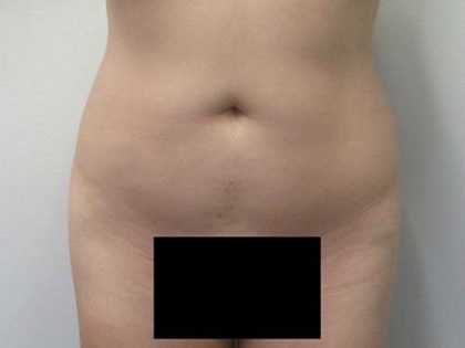 Liposuction Before & After Patient #9219