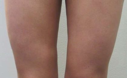 Liposuction Before & After Patient #9233