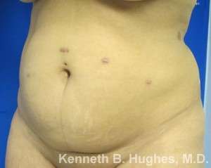 Liposuction Before & After Patient #9240