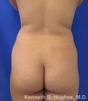 Liposuction Before & After Patient #9245