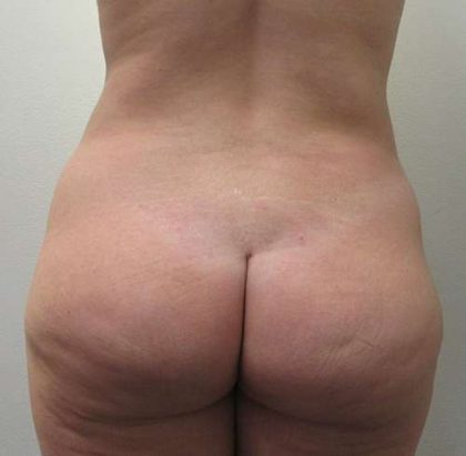 Brazilian Butt Lift Before & After Patient #6214