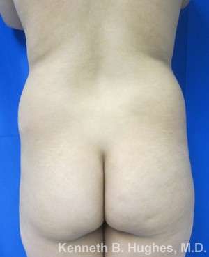 Liposuction Before & After Patient #9248