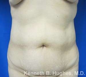 Liposuction Before & After Patient #9255