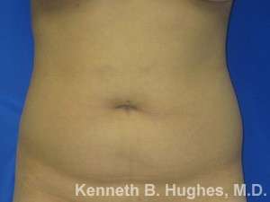 Liposuction Before & After Patient #9258