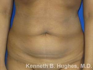 Liposuction Before & After Patient #9261