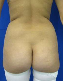 Liposuction Before & After Patient #9264