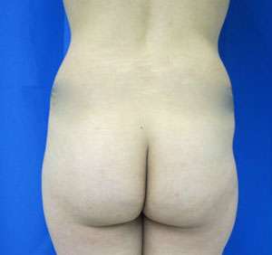 Liposuction Before & After Patient #9267