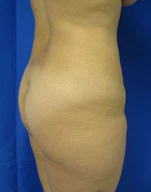 Liposuction Before & After Patient #9270