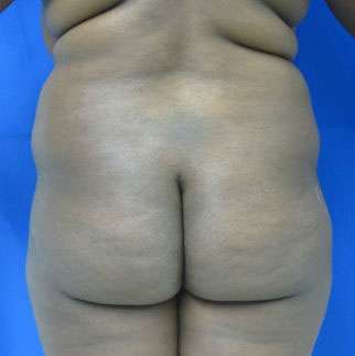 Liposuction Before & After Patient #9276