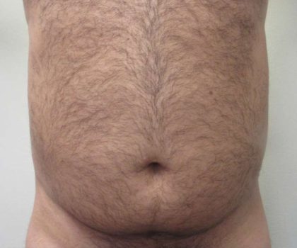 Brazilian Butt Lift Before & After Patient #6223