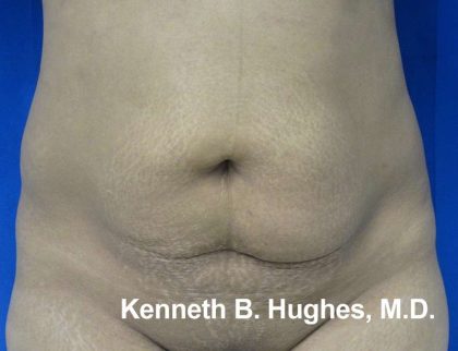 Liposuction Before & After Patient #9284